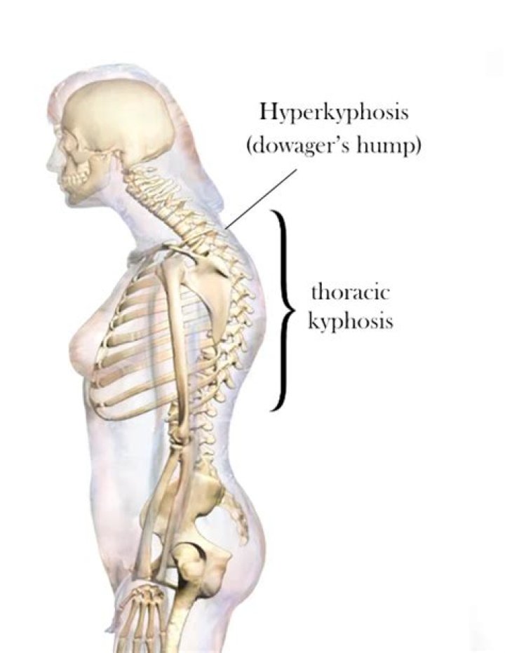 What is a neck hump?