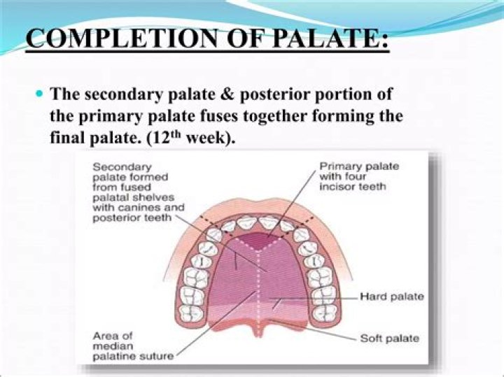 What is a steepled palate?