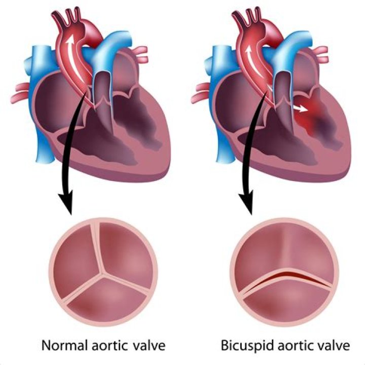 What is a unicuspid aortic valve?