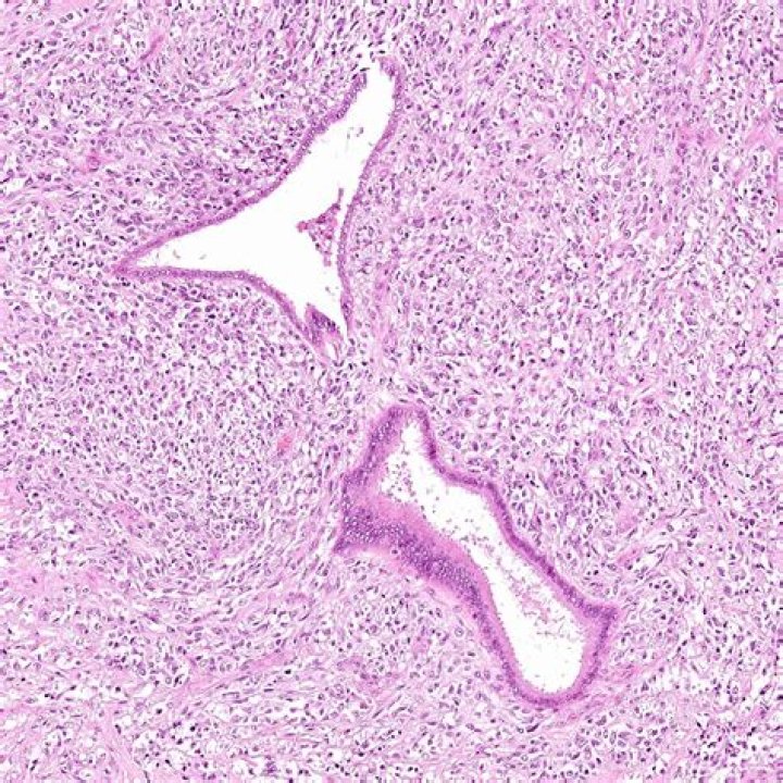 What is adenosarcoma pathology?