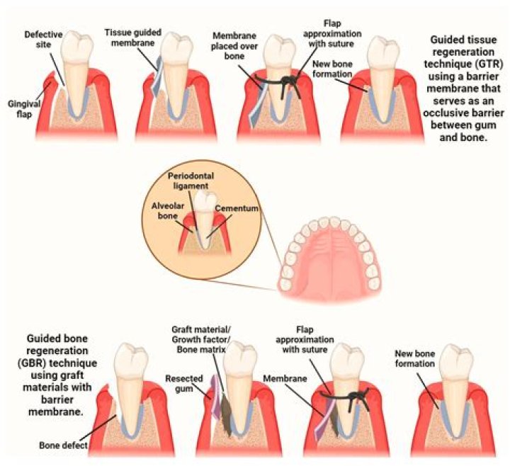 What is alloplastic graft?