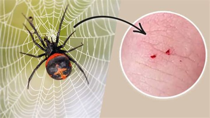What is black widow spider envenomation?