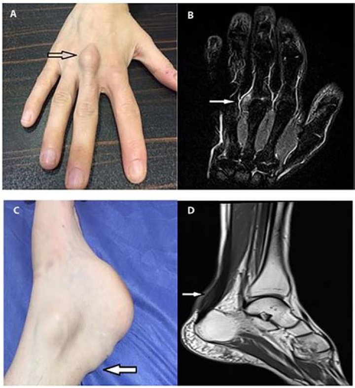 What is cerebrotendinous xanthomatosis?