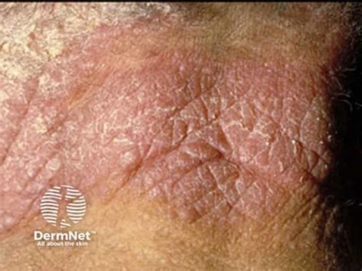 What is chronic actinic dermatitis?