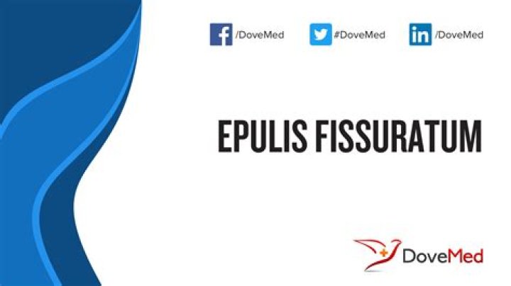 What is epulis fissuratum?