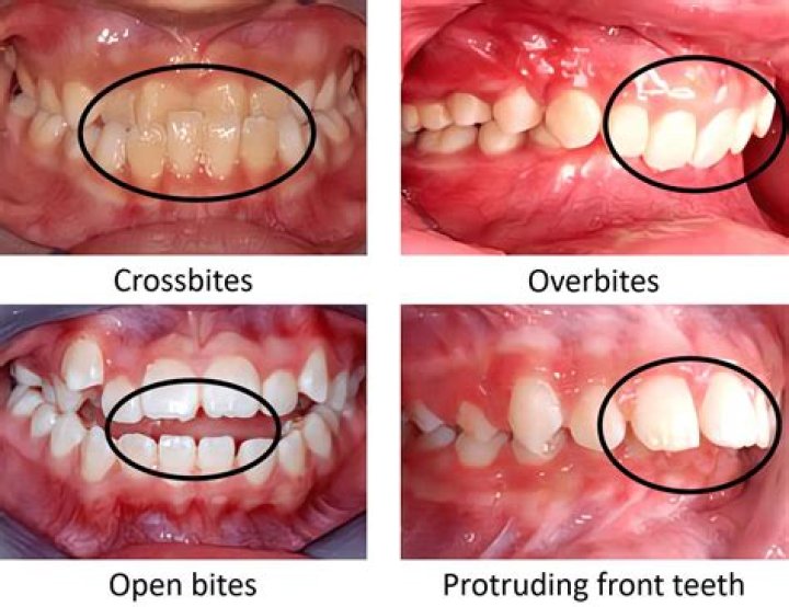 What is interceptive orthodontic treatment?