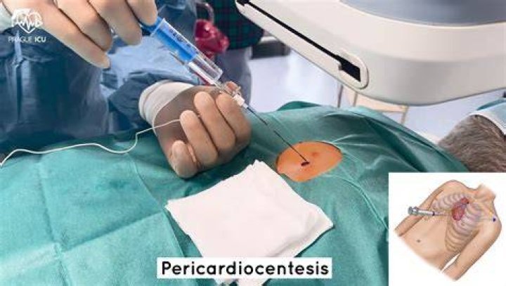 What is pericardiocentesis in english?
