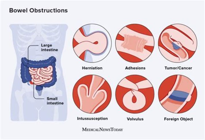 What is strangulated bowel obstruction?