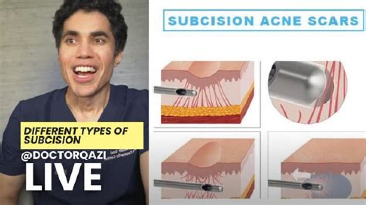 What is subcision procedure?