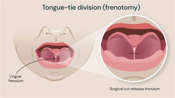What is tongue tied surgery?