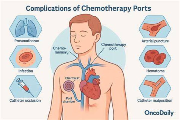 Whats a port for chemo?