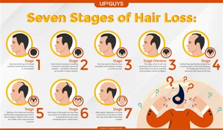 When does baldness start?