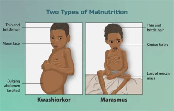 When does malnourished mean?