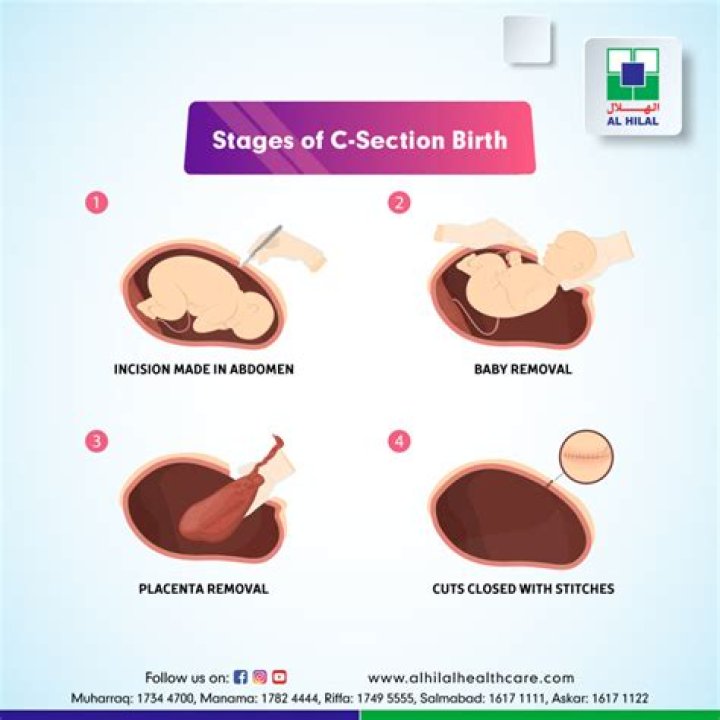 When should a cesarean be performed?