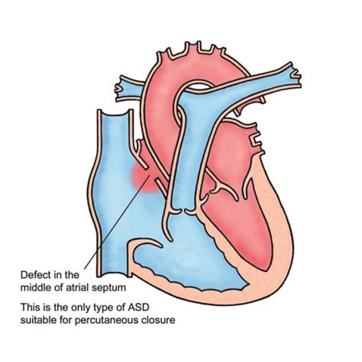 When to close secundum asd?