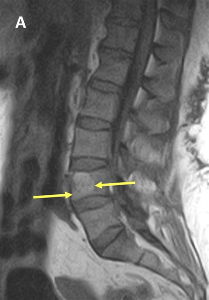 Where are hemangiomas found?