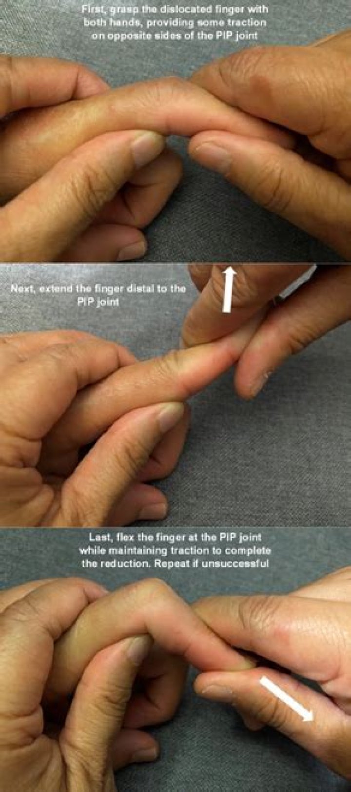 Where does a jammed finger hurt?