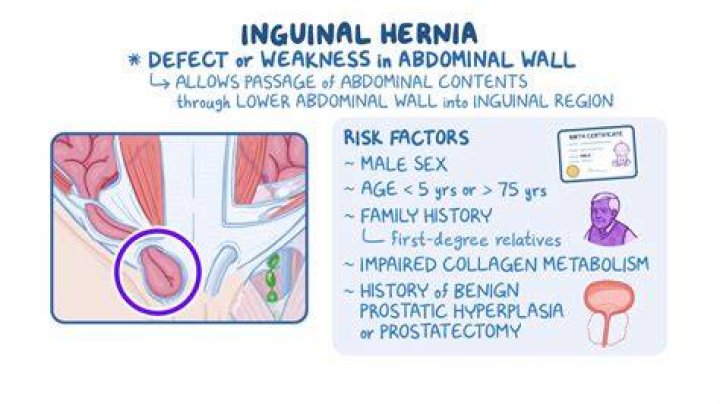 Where does strangulated hernia occur?