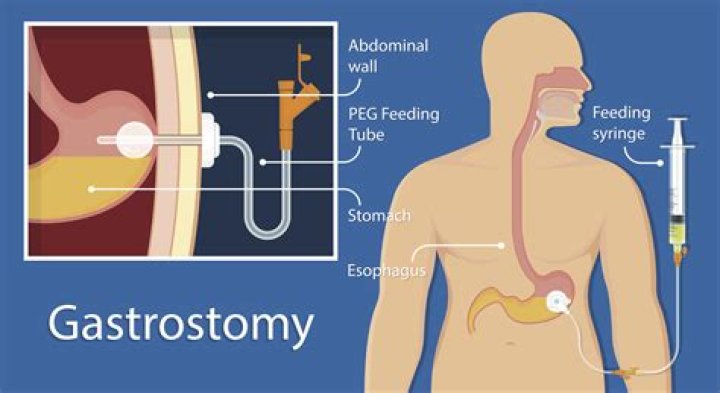 Where is gastrostomy tube placed?