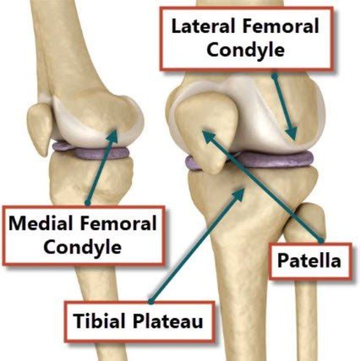 Where is the medial femoral condyle?