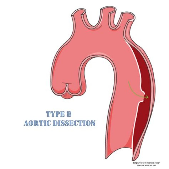 Where is type b aortic dissection?