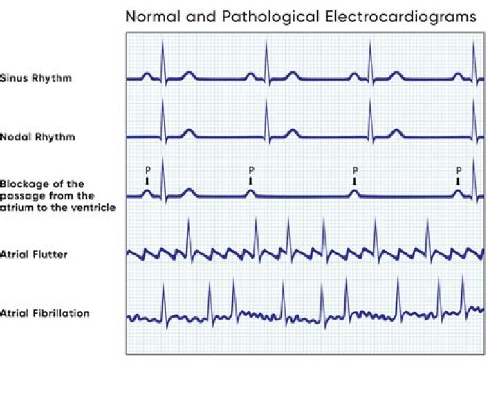 Which arrhythmia is often implicated with embolic strokes?