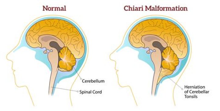 Which chiari malformation is worse?