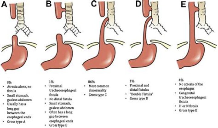 Who does esophageal atresia affect?