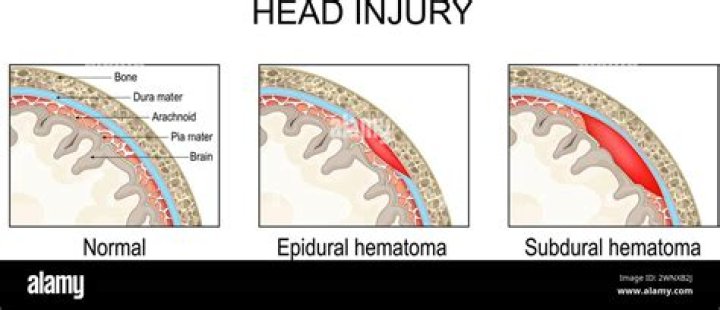Who gets extradural hematoma?