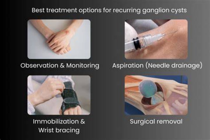 Who remove ganglion cysts orthopedic surgeons?