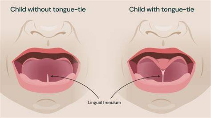 Why am i always tongue tied?