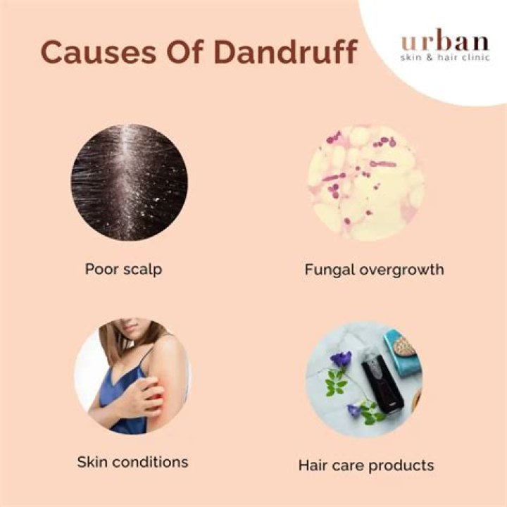 Why dandruff is not going?