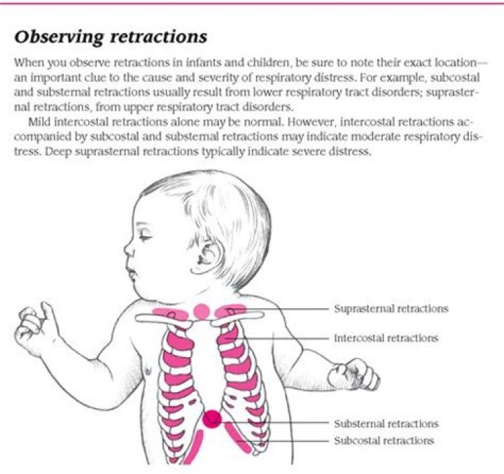 Why do babies have retractions?