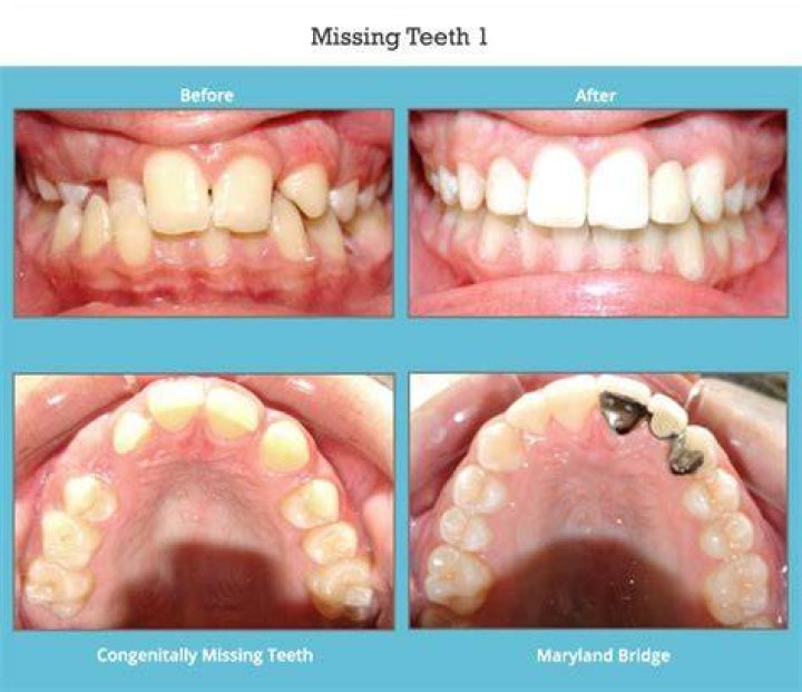 Why do i have congenitally missing teeth?