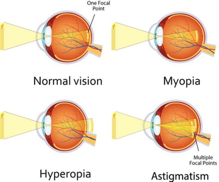 Why does hyperopia happen?