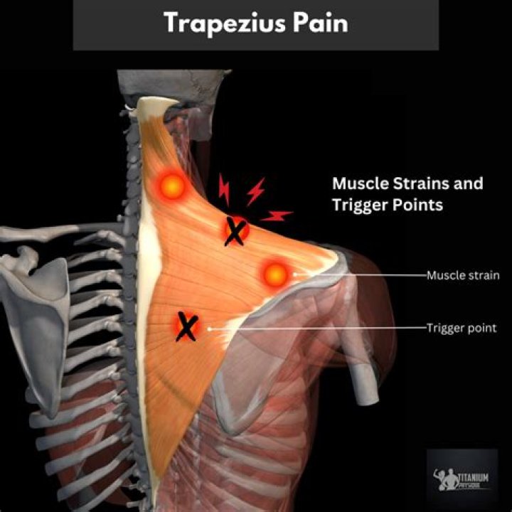 Why does my trapezius muscle burn?