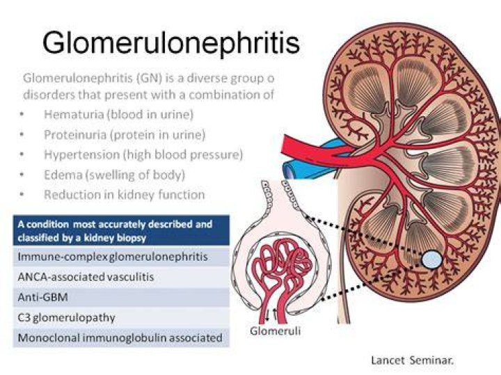 Why glomerulonephritis causes hypertension?