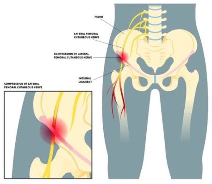 Why is meralgia paresthetica worse at night?