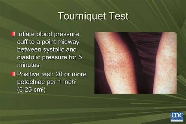 Why tourniquet test is done?