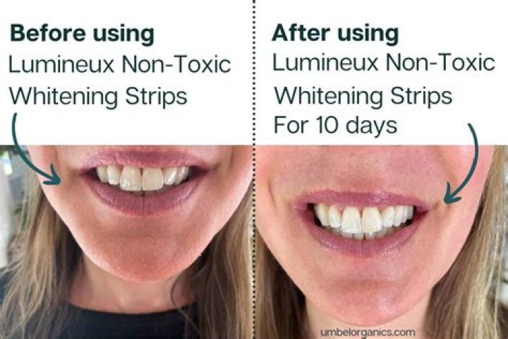Why whitening strips don't work?