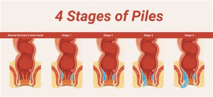 Will an external hemorrhoid go away?