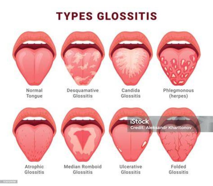 Will glossitis go away?