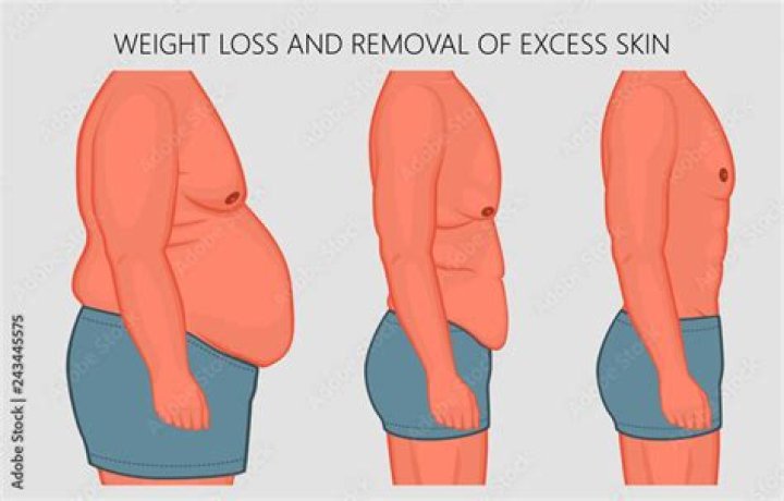 Will i have excess skin from weight loss?