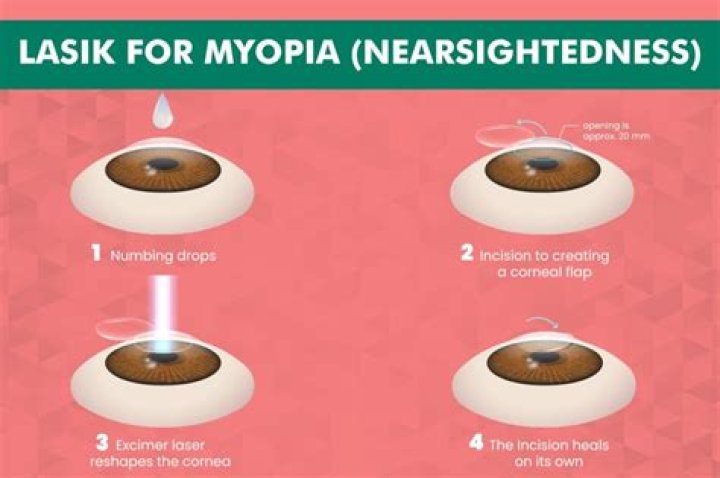 Will lasik correct nearsightedness?