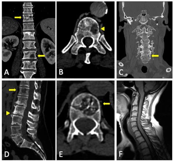 Will multiple myeloma show up on mri?