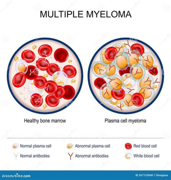 Would blood work show multiple myeloma?