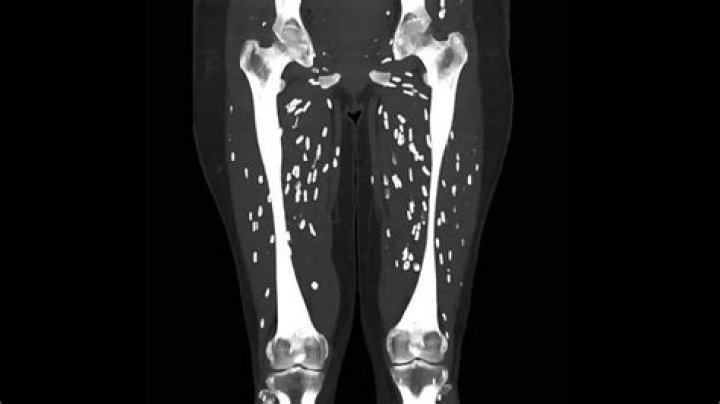 Would tapeworm show up on mri?