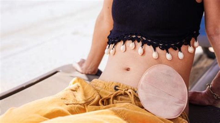 Would you date someone with a colostomy bag?
